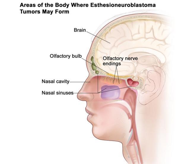 استزیونوروبلاستوما ، تومور نادر بینی ، علائم و نشانه های آن